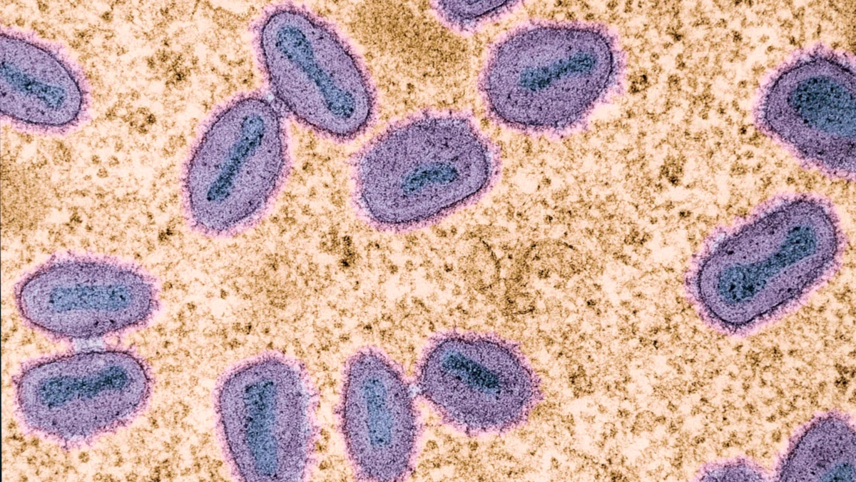 Symptoms of monkeypox